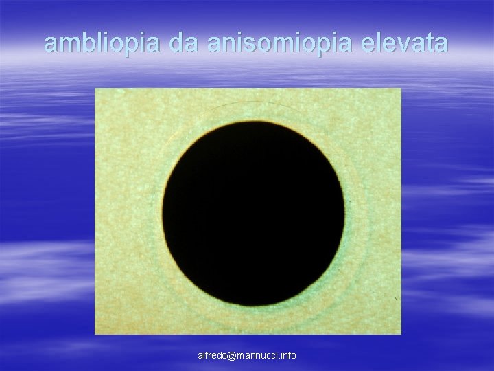 ambliopia da anisomiopia elevata alfredo@mannucci. info ambliopia da anisomiopia elevata alfredo@mannucci. info