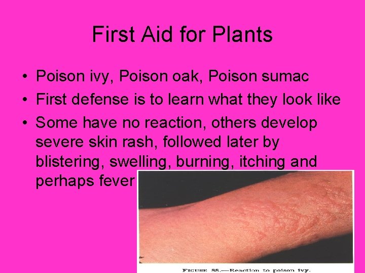 First Aid for Plants • Poison ivy, Poison oak, Poison sumac • First defense