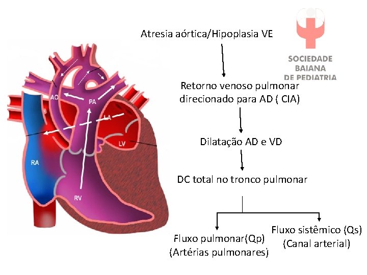 Atresia aórtica/Hipoplasia VE Retorno venoso pulmonar direcionado para AD ( CIA) Dilatação AD e
