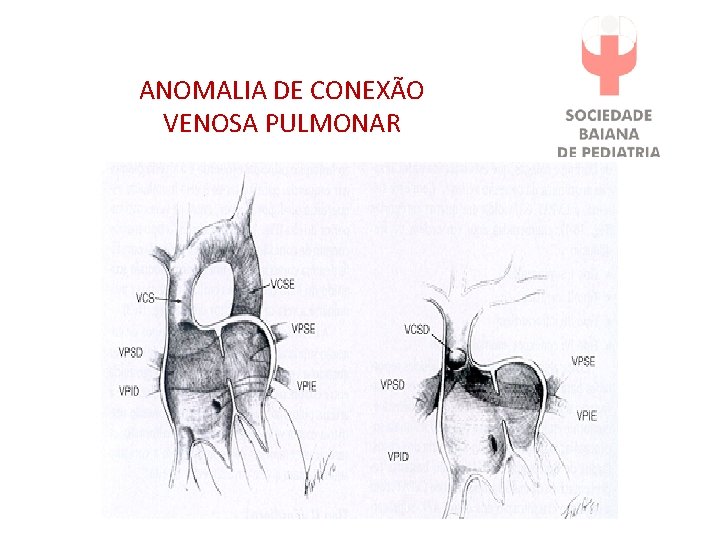 ANOMALIA DE CONEXÃO VENOSA PULMONAR ANOMALIA DE CONEXÃO VENOSA PULMONAR