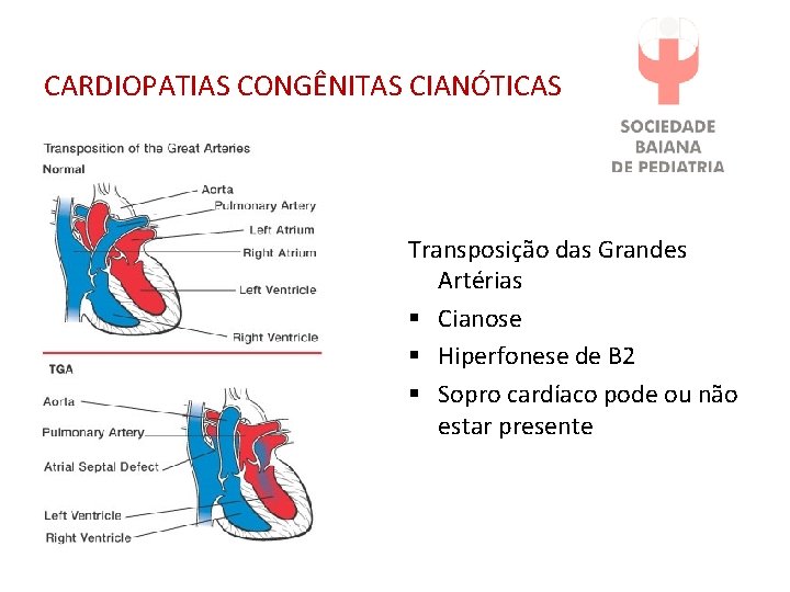 CARDIOPATIAS CONGÊNITAS CIANÓTICAS Transposição das Grandes Artérias § Cianose § Hiperfonese de B 2 CARDIOPATIAS CONGÊNITAS CIANÓTICAS Transposição das Grandes Artérias § Cianose § Hiperfonese de B 2