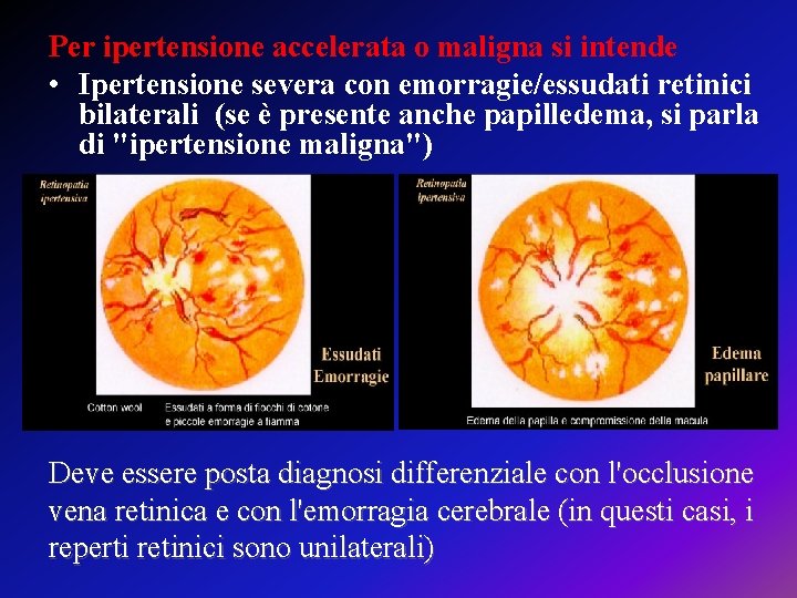 Per ipertensione accelerata o maligna si intende • Ipertensione severa con emorragie/essudati retinici bilaterali