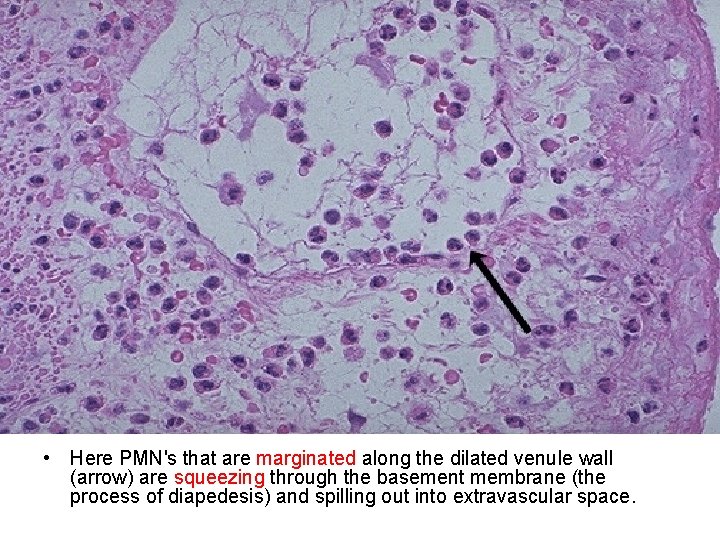  • Here PMN's that are marginated along the dilated venule wall (arrow) are