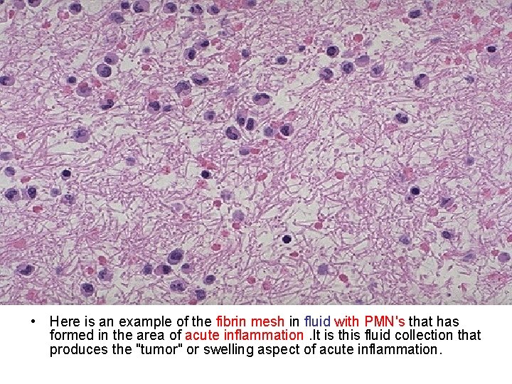  • Here is an example of the fibrin mesh in fluid with PMN's