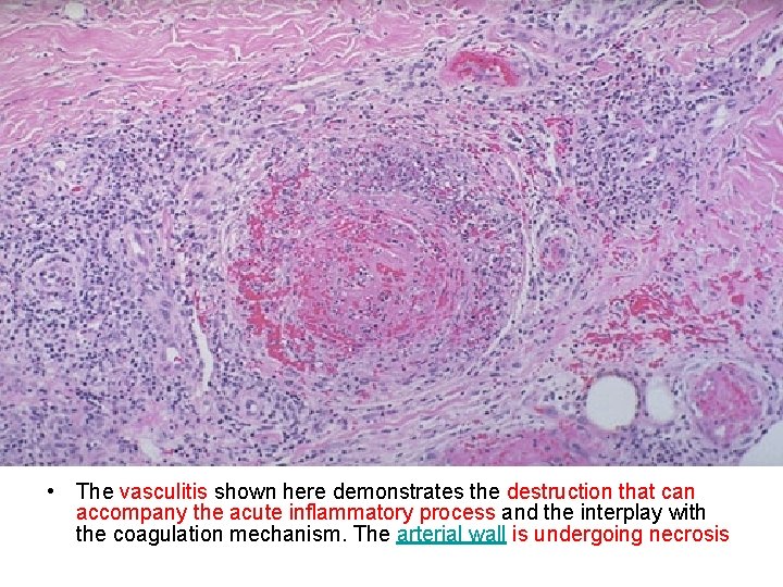  • The vasculitis shown here demonstrates the destruction that can accompany the acute