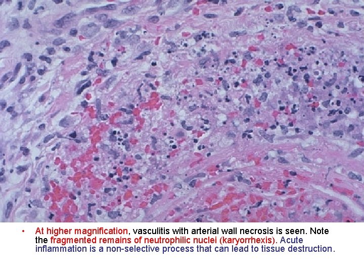  • At higher magnification, vasculitis with arterial wall necrosis is seen. Note the