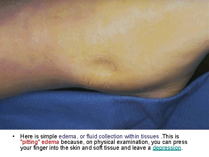  • Here is simple edema, or fluid collection within tissues. This is "pitting"