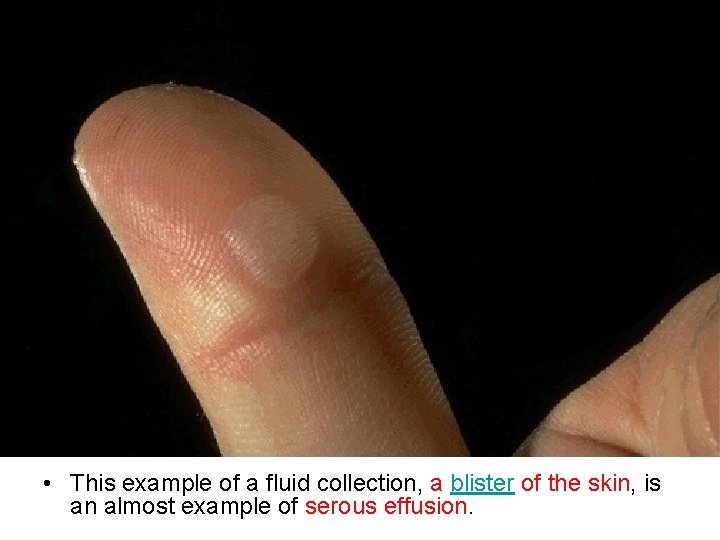  • This example of a fluid collection, a blister of the skin, is