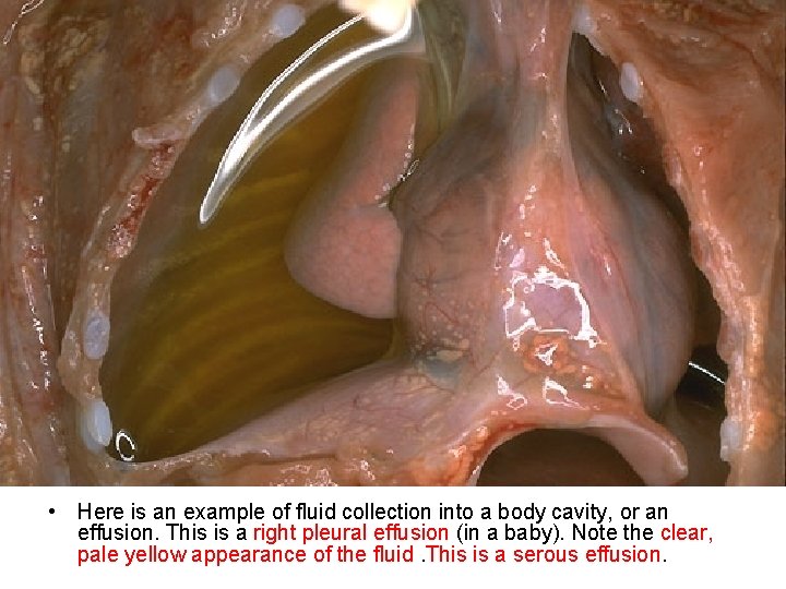  • Here is an example of fluid collection into a body cavity, or
