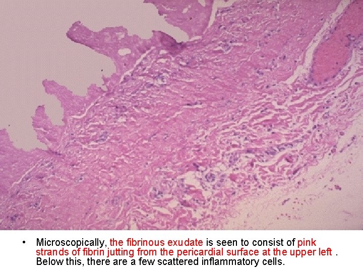  • Microscopically, the fibrinous exudate is seen to consist of pink strands of