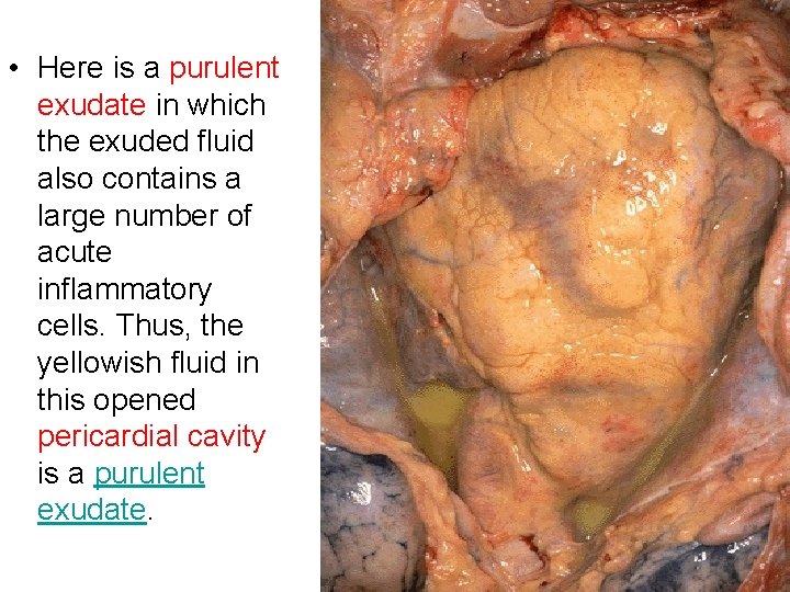  • Here is a purulent exudate in which the exuded fluid also contains