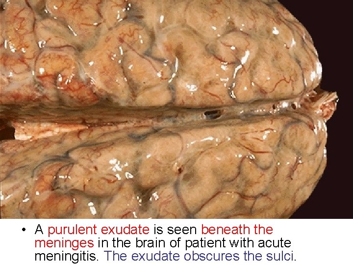 • A purulent exudate is seen beneath the meninges in the brain of