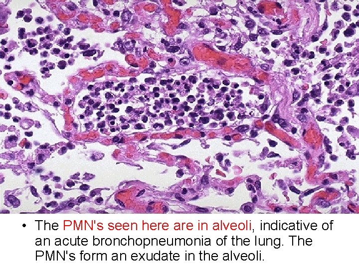  • The PMN's seen here are in alveoli, indicative of an acute bronchopneumonia