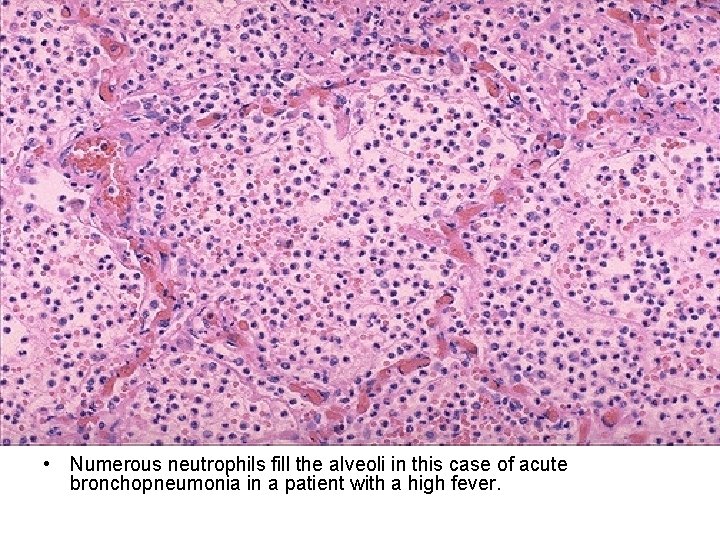  • Numerous neutrophils fill the alveoli in this case of acute bronchopneumonia in