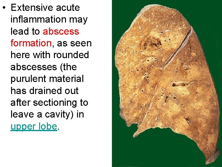  • Extensive acute inflammation may lead to abscess formation, as seen here with