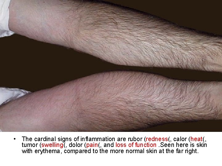  • The cardinal signs of inflammation are rubor (redness(, calor (heat(, tumor (swelling(,