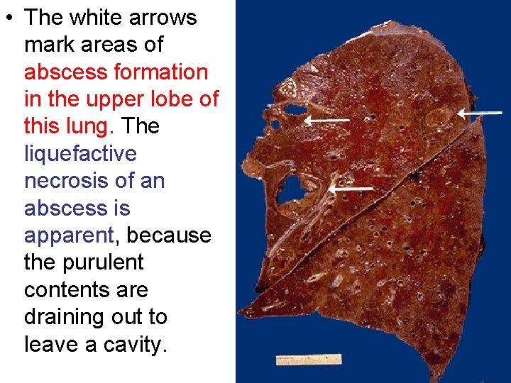  • The white arrows mark areas of abscess formation in the upper lobe