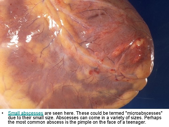  • Small abscesses are seen here. These could be termed "microabscesses" due to