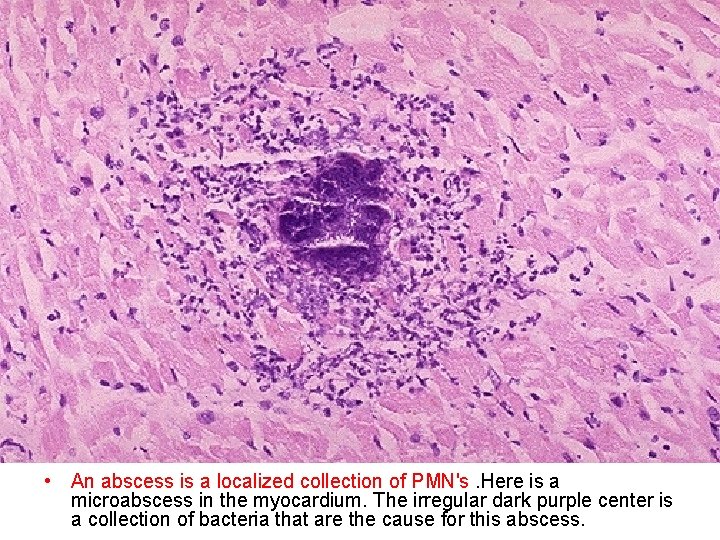  • An abscess is a localized collection of PMN's. Here is a microabscess