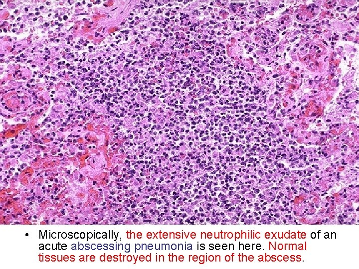  • Microscopically, the extensive neutrophilic exudate of an acute abscessing pneumonia is seen