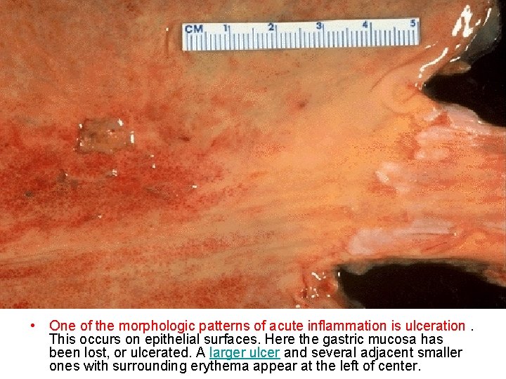  • One of the morphologic patterns of acute inflammation is ulceration. This occurs