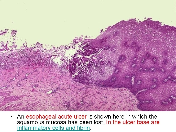  • An esophageal acute ulcer is shown here in which the squamous mucosa