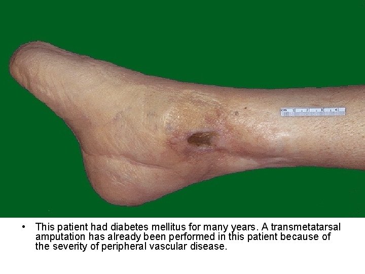  • This patient had diabetes mellitus for many years. A transmetatarsal amputation has