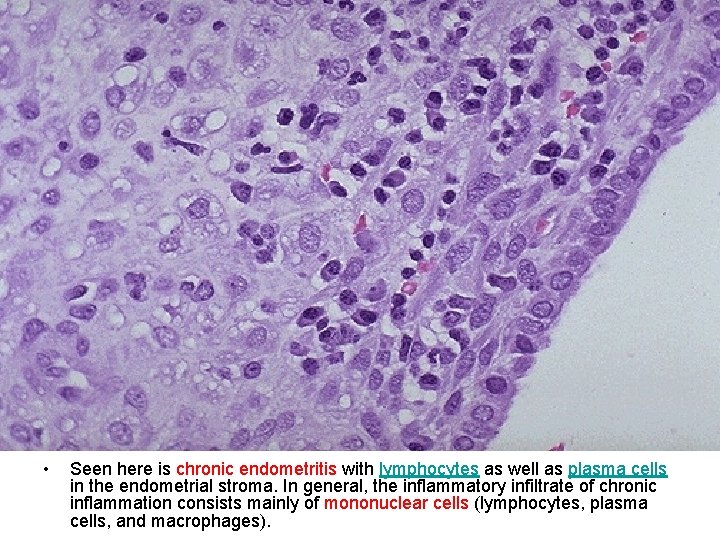  • Seen here is chronic endometritis with lymphocytes as well as plasma cells