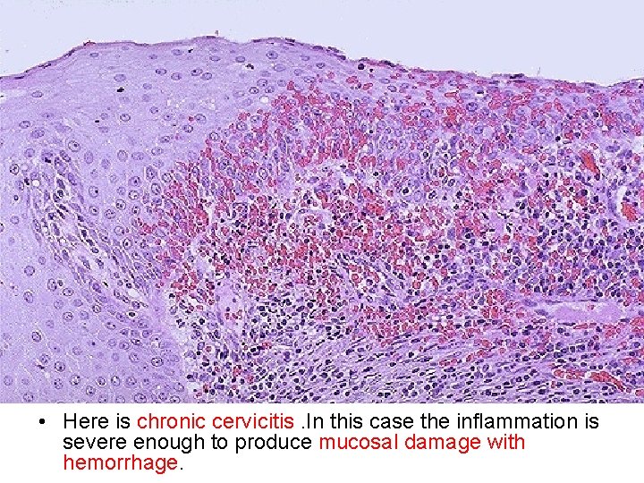  • Here is chronic cervicitis. In this case the inflammation is severe enough