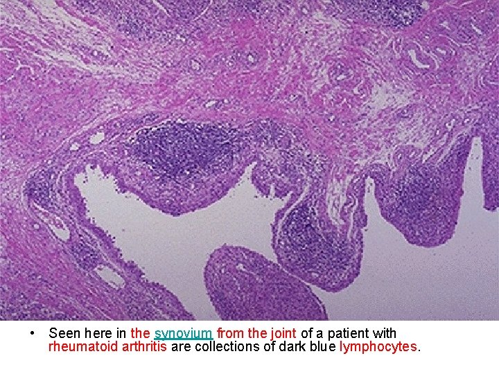  • Seen here in the synovium from the joint of a patient with