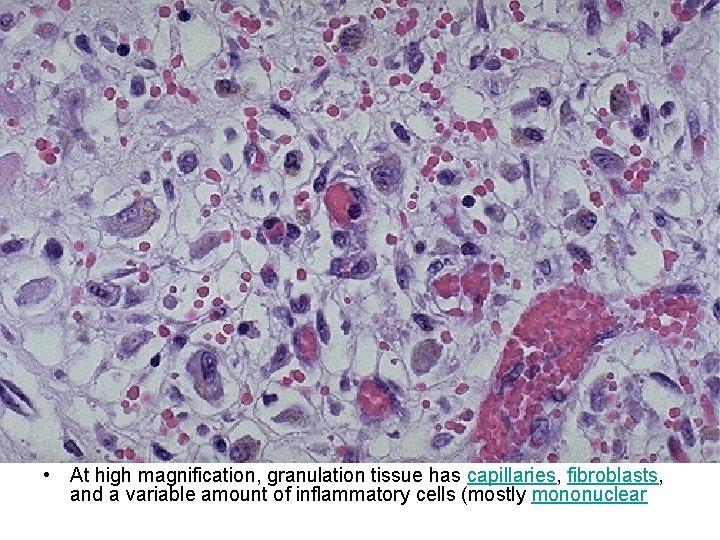  • At high magnification, granulation tissue has capillaries, fibroblasts, and a variable amount