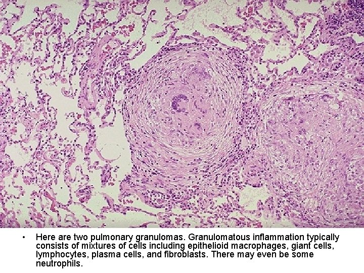  • Here are two pulmonary granulomas. Granulomatous inflammation typically consists of mixtures of