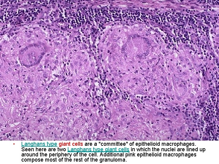  • Langhans type giant cells are a "committee" of epithelioid macrophages. Seen here