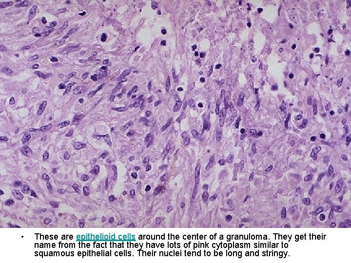  • These are epithelioid cells around the center of a granuloma. They get