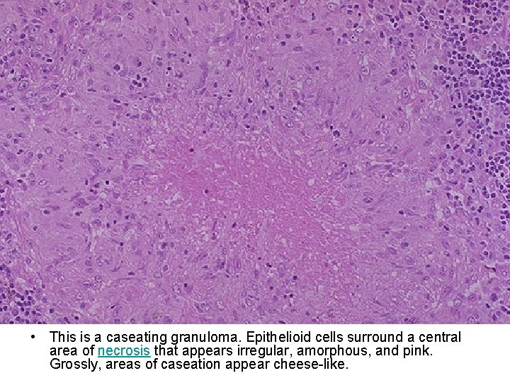  • This is a caseating granuloma. Epithelioid cells surround a central area of