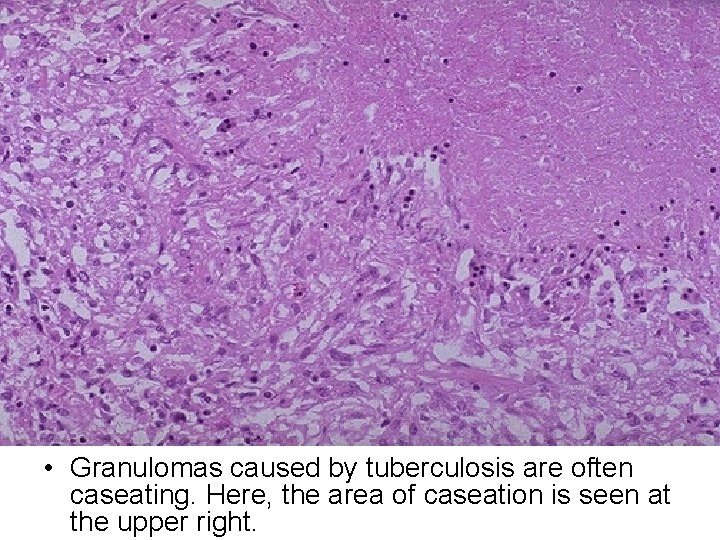  • Granulomas caused by tuberculosis are often caseating. Here, the area of caseation