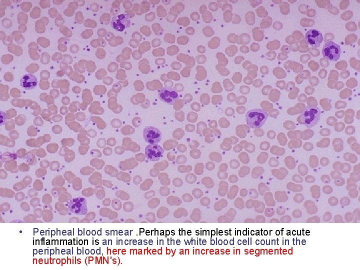  • Peripheal blood smear. Perhaps the simplest indicator of acute inflammation is an