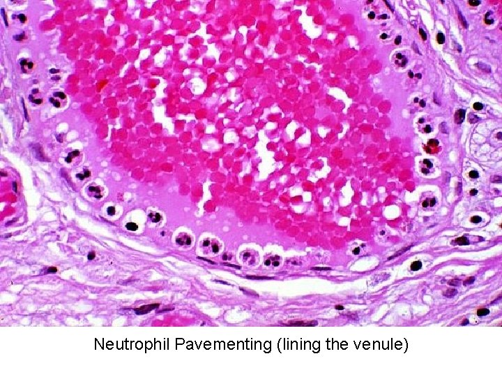 Neutrophil Pavementing (lining the venule) 