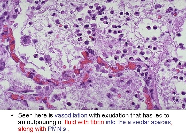  • Seen here is vasodilation with exudation that has led to an outpouring