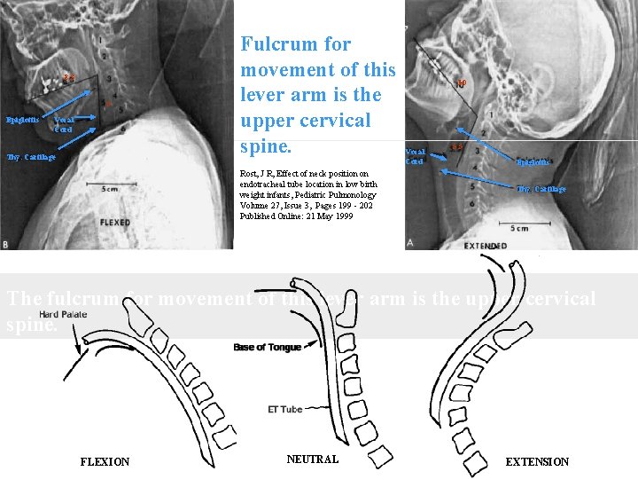 8. 3 5 Epiglottis Vocal Cord Thy. Cartilage Fulcrum for movement of this lever 8. 3 5 Epiglottis Vocal Cord Thy. Cartilage Fulcrum for movement of this lever