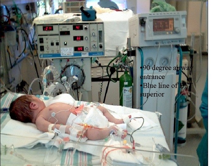 • 90 degree airway entrance • Blue line of ETT superior • 90 degree airway entrance • Blue line of ETT superior