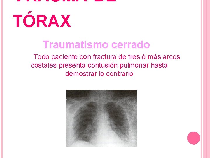 TRAUMA DE TÓRAX Traumatismo cerrado Todo paciente con fractura de tres ó más arcos