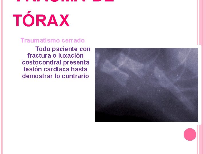 TRAUMA DE TÓRAX Traumatismo cerrado Todo paciente con fractura o luxación costocondral presenta lesión