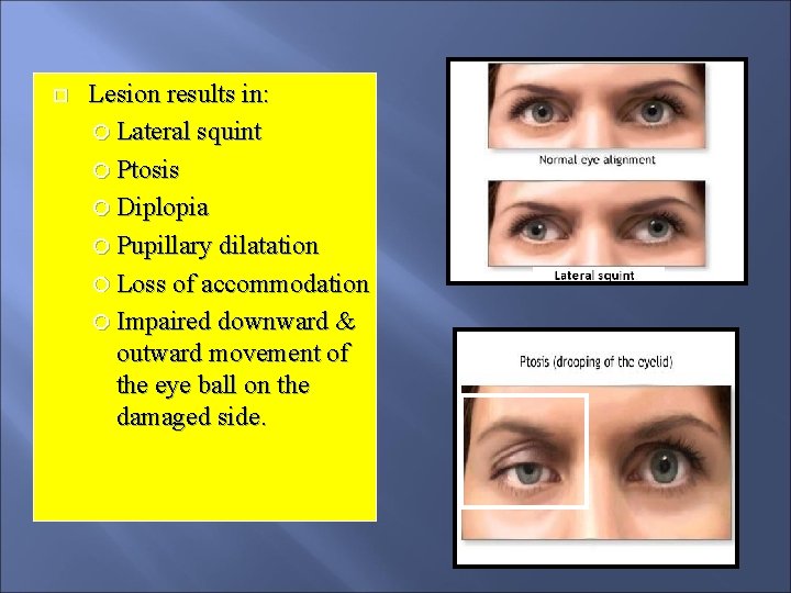  Lesion results in: Lateral squint Ptosis Diplopia Pupillary dilatation Loss of accommodation Impaired