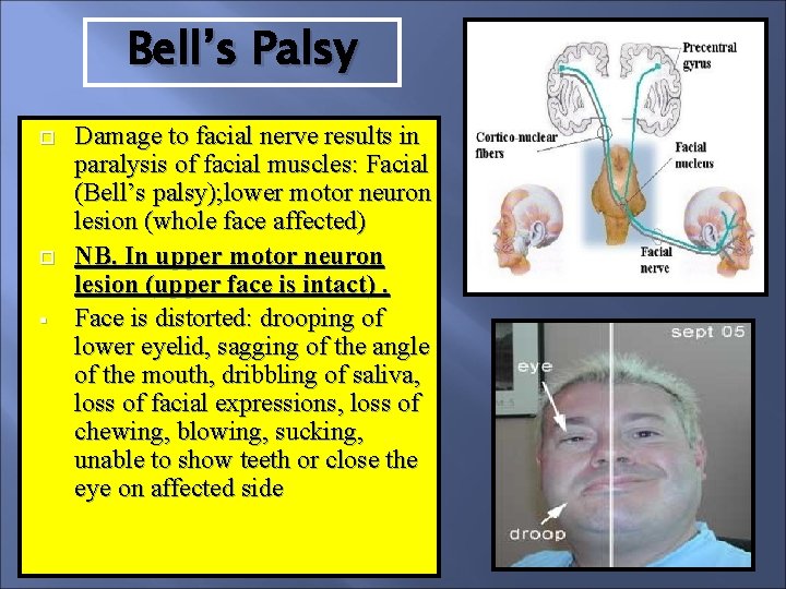 Bell’s Palsy § Damage to facial nerve results in paralysis of facial muscles: Facial