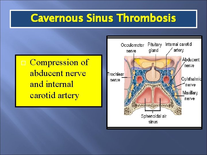 Cavernous Sinus Thrombosis Compression of abducent nerve and internal carotid artery 