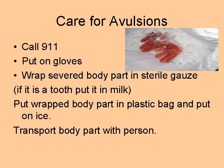 Care for Avulsions • Call 911 • Put on gloves • Wrap severed body