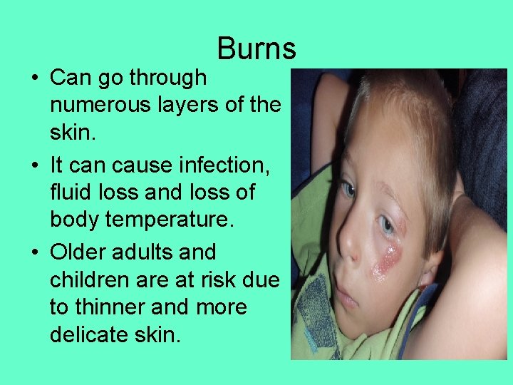 Burns • Can go through numerous layers of the skin. • It can cause