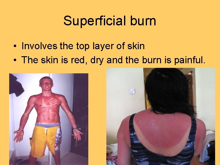 Superficial burn • Involves the top layer of skin • The skin is red,