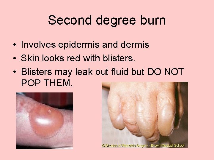 Second degree burn • Involves epidermis and dermis • Skin looks red with blisters.